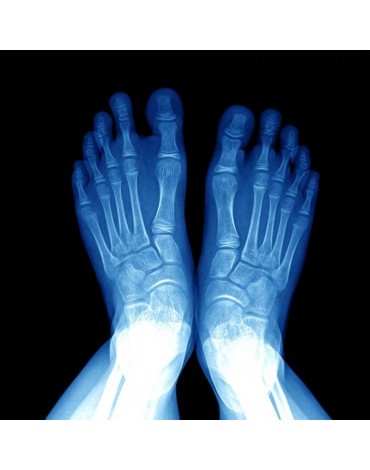 X-ray of both feet