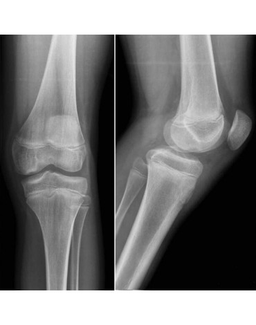 Radiografía de rodilla ap y lat