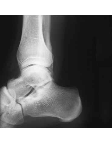 X-ray of the calcaneus (heel)