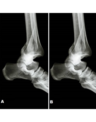 Radiografía de ambos calcáneos (talones)