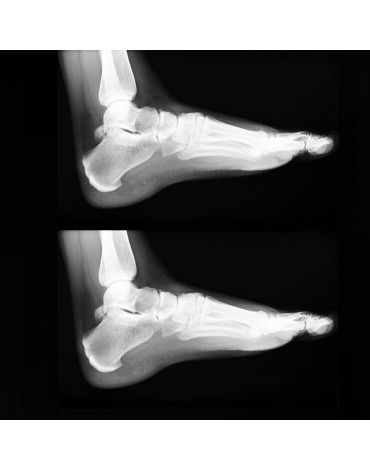 X-ray of ankles (both)