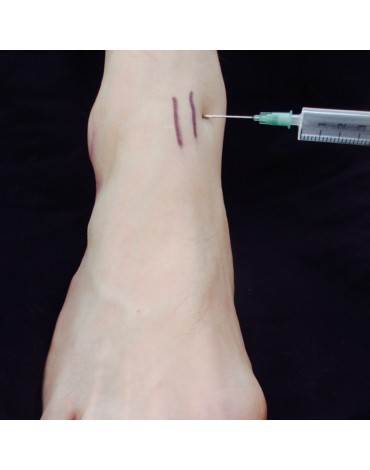 Ankle infiltration