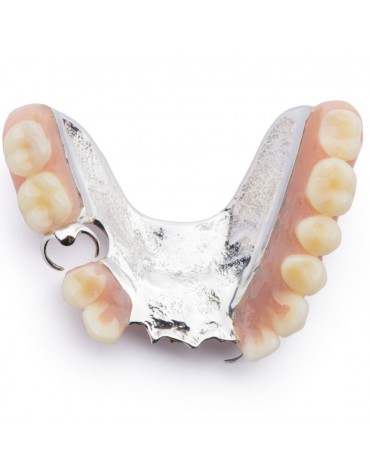 Removable partial denture metal   chrome - cobalt (skeletal prostheses)