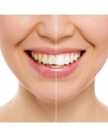 Dental chair whitening (clinic whitening)