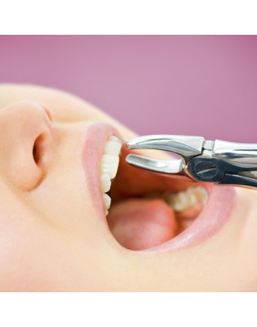 Exodoncia (extracción dental)   