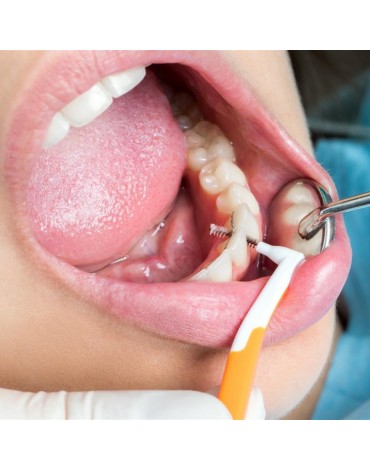 Dental cleaning (dental prophylaxis)
