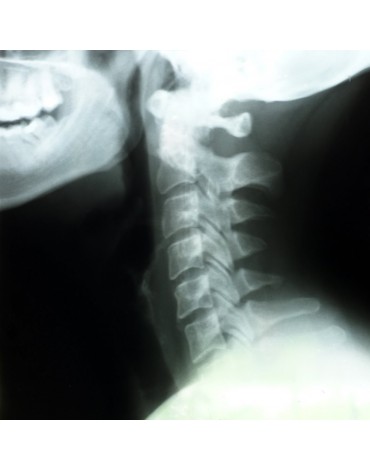 X-ray of cervical column