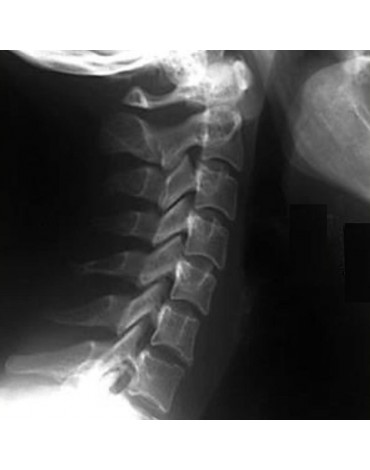 X-ray of cervical column