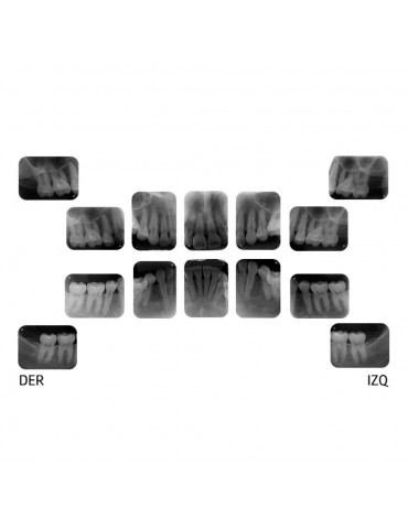 Periapical radiography (intrabuccal radiography)