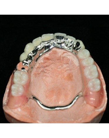 Removable partial denture metal  chrome - cobalt (Skeletal)