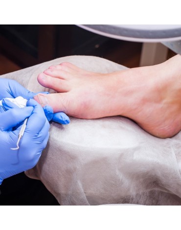 Onychoplasty for ingrown toenail