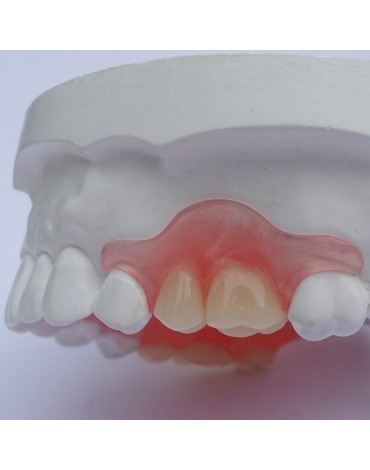 Immediate acrylic removable partial denture (immediate acrylic removable partial denture)