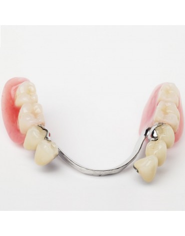 Removable partial denture metal chrome  cobalt (Skeletal)