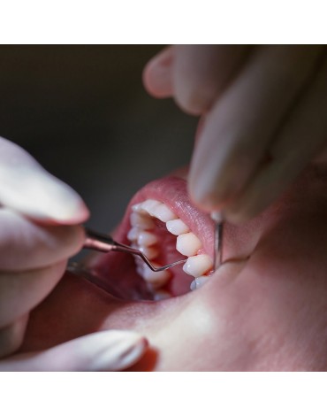 Raspado manual por sesión  (tratamiento   para la periodontitis)  