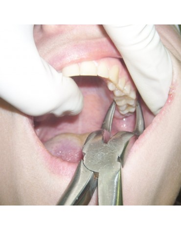 Exodoncia compleja  (extracción dental compleja)