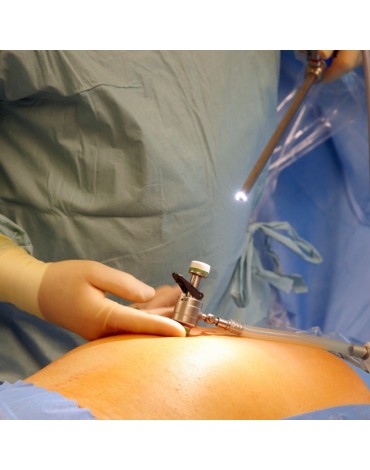 Hysterectomy by laparoscopy