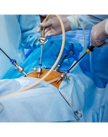 Myomectomy by laparoscopy 