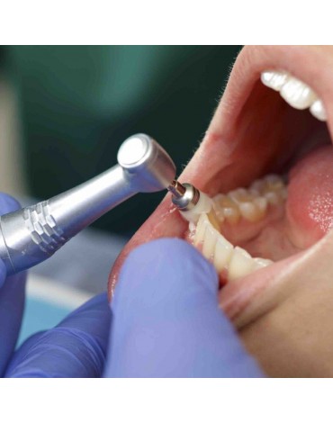 Profilaxis dental   (tratamiento dental preventivo)