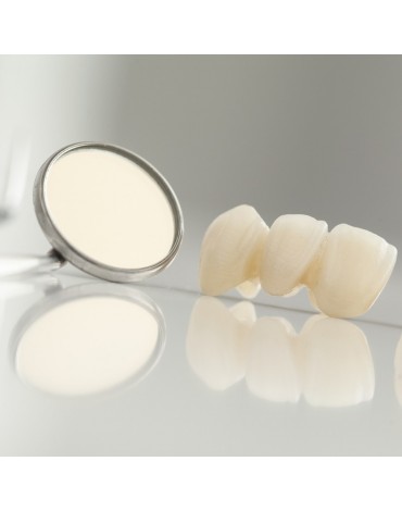 Puente dental (restauraciones dentales fijas)  