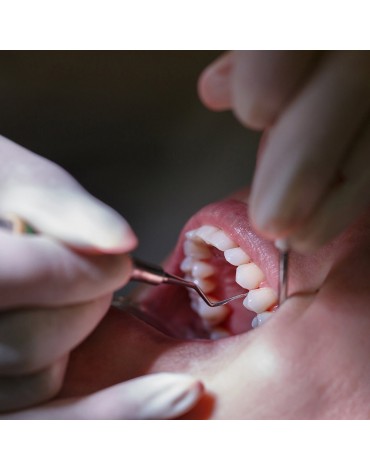 Dental scraping (treatment for periodontitis)