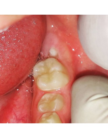 Surgery of third molars semi-erupted in malposition