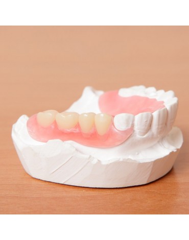 Immediate Acrylic Removable Partial Prosthesis (Immediate Acrylic Removable Partial Dentures)