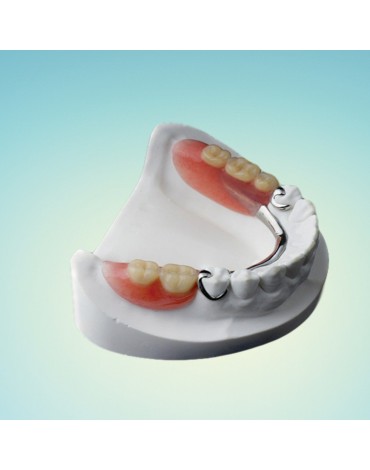 Removable partial denture metal   chrome  cobalt (skeletal prostheses)