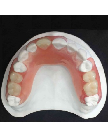 Prótesis parcial removible acrílica inmediata (dentadura postiza parcial removible acrílica inmediata)