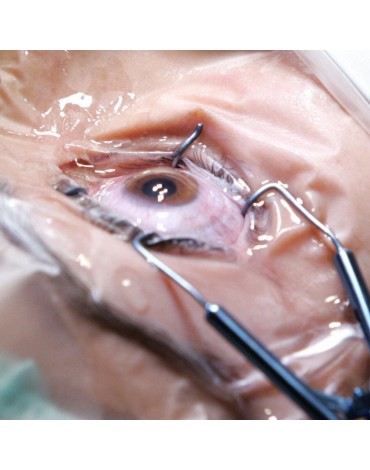 Cataract surgery with german intraocular lens