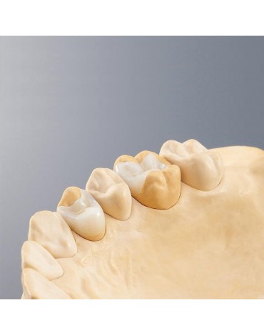 Zirconium and / or porcelain inlays (Zirconium and / or porcelain graft)