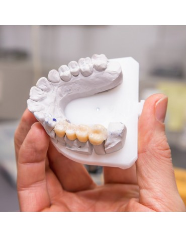 Dental bridge (fixed dental restorations)