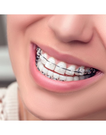 Orthodontic treatment