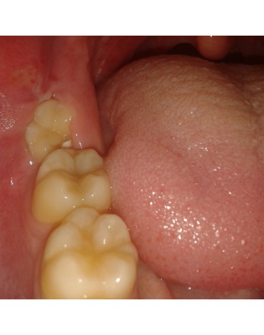 Cirugía de terceras molares semi-erupcionadas en malposición