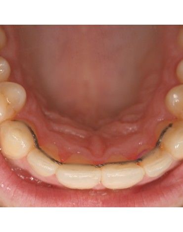 Ferulización (sostén dental)  