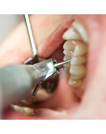 Endodoncia premolar birradicular  (tratamiento de nervio en dientes de dos raíces)  