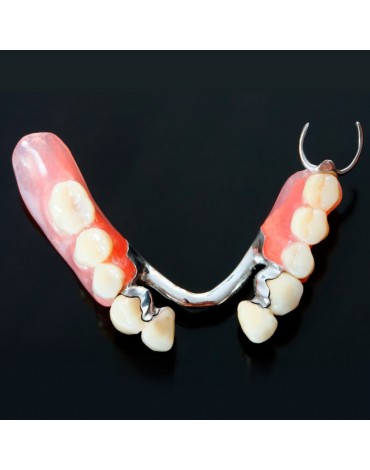 Removable partial denture metal chrome  cobalt (skeletal)