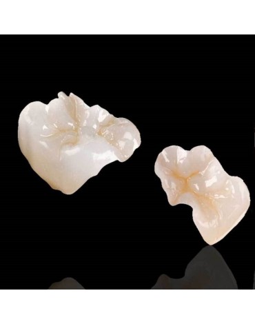 Zirconium and / or porcelain inlays (Zirconium and / or porcelain graft)