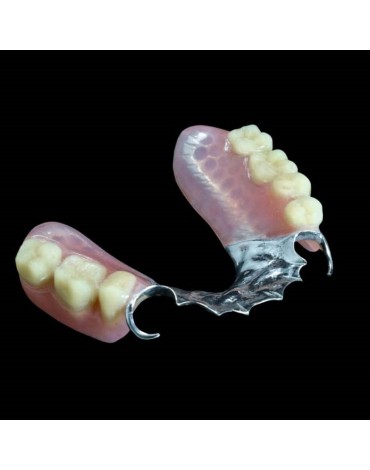 Removable partial denture metal   chrome  cobalt (skeletal prostheses)