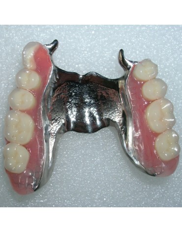 Removable partial denture metal  chrome  cobalt (skeletal prostheses)