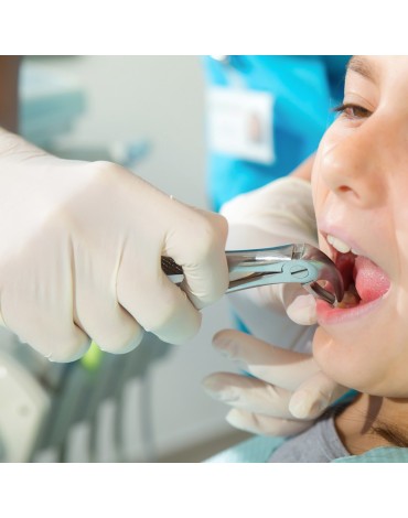 Temporary tooth exodontics (milk tooth extraction)