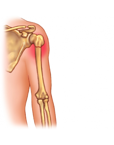 Humerus fracture