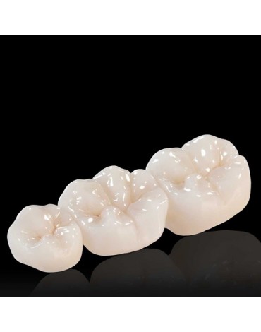 Zirconium bridges (fixed dental restorations of zirconium)
