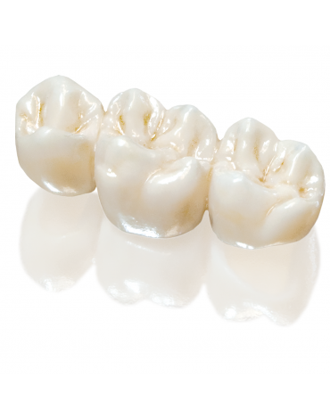 Zirconium bridges (fixed dental restorations of zirconium)