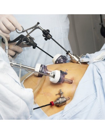 Hysterectomy by laparoscopy