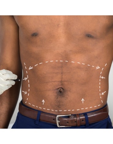 Liposuction of abdomen