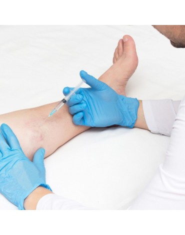 Sclerotherapy with foam