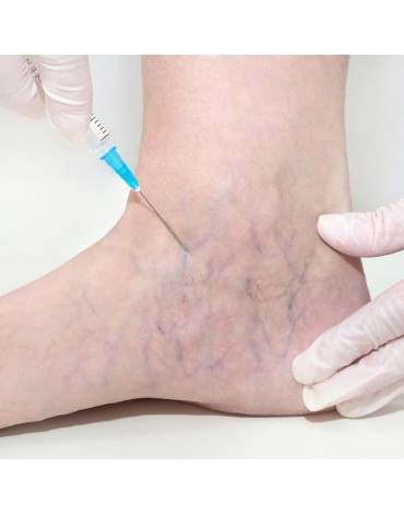 Sclerotherapy treatment (each session)