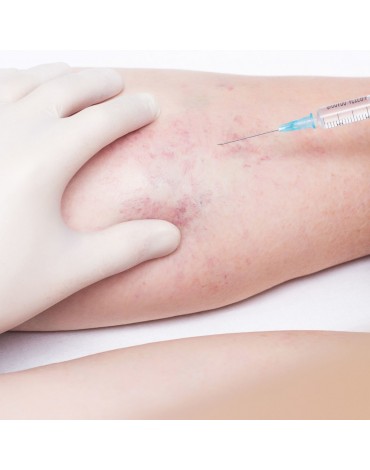 Sclerotherapy treatment (each session)