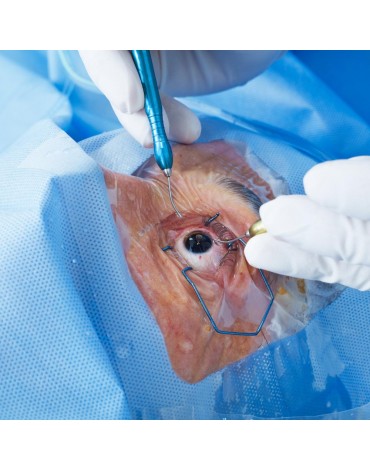 Cataract surgery with multifocal or trifocal lens (each eye)