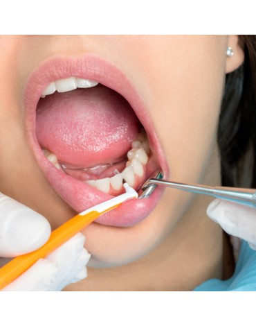 Dental cleaning (dental prophylaxis)